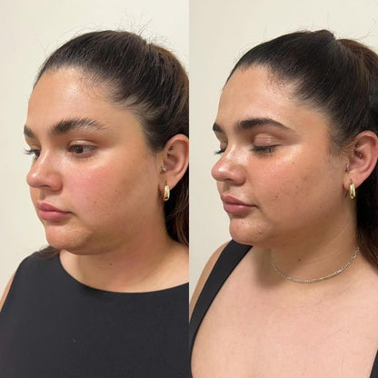 LiftyBand™ – Banda reafirmante facial