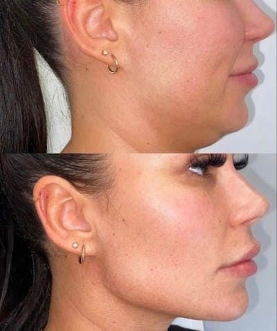 LiftyBand™ – Banda reafirmante facial